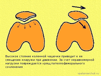 пателлофеморальный артроз, латеропозиция коленной чашечки
