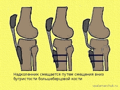 Высокое стояние надколенника