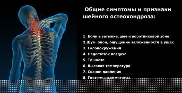 Корешковый синдром на фоне остеохондроза