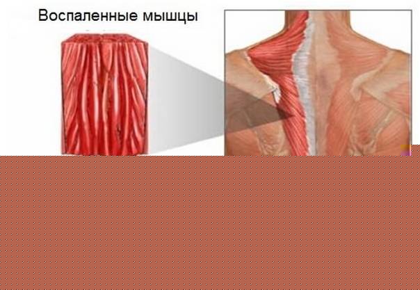 Воспаленные мышцы при миозите