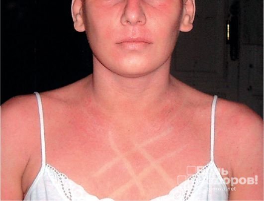Белый дермографизм