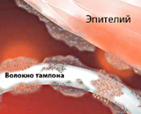 Синдром токсического шока Синдром токсического шока