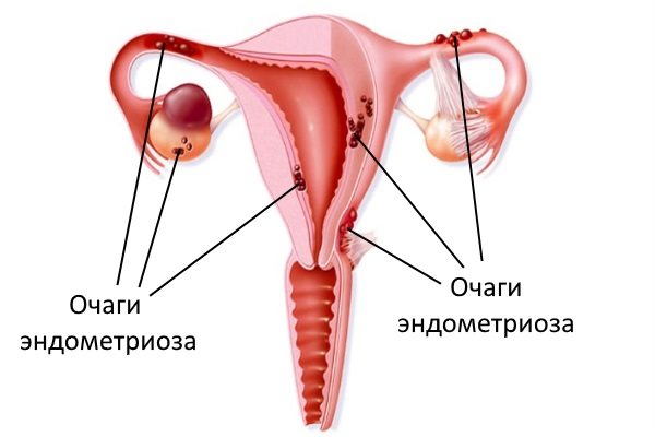Электрофорез при эндометриозе