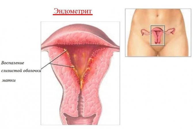 Эндометрит