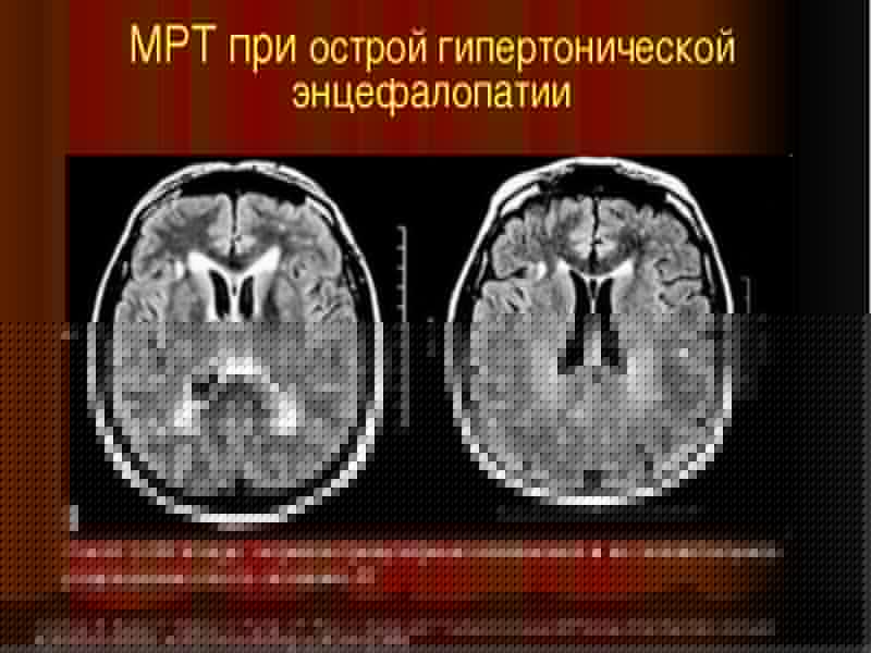 Гипертоническая энцефалопатия