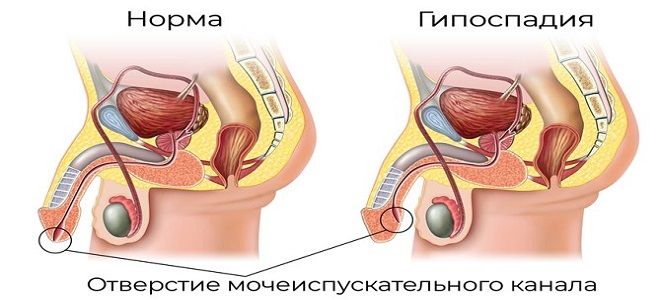 гипоспадия что это