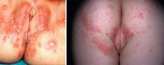 herpes у женщин