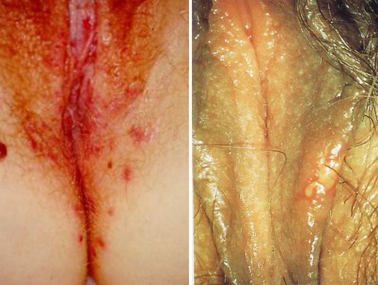 herpes у женщин