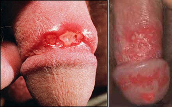 herpes virus у мужчин