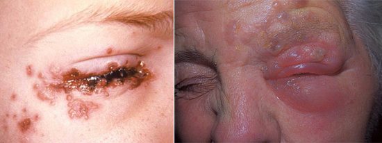 Herpes zoster на глазах