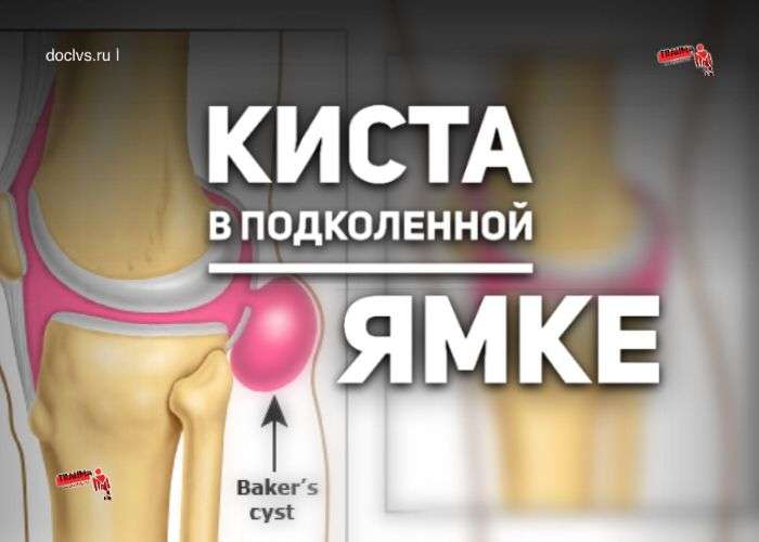 Киста Бейкера (Беккера): что это, какие причины, симптомы, диагностика, методы лечения кисты в подколенной ямке Киста Бейкера (Беккера): что это, какие причины, симптомы, диагностика, методы лечения кисты в подколенной ямке