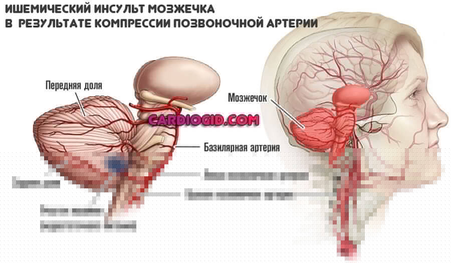 ишемия-мозжечка-в-результате-СПА
