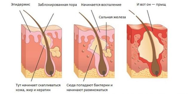 Как избавиться от прыщей: причины прыщей