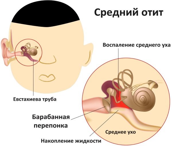 Кривошея у новорожденных. Причины, признаки, фото и лечение