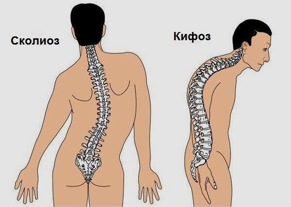 Кифоз и сколиоз