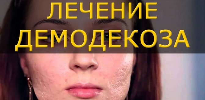 Лечение демодекоза