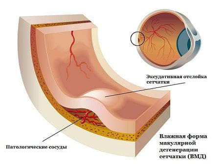 Макулярная дистрофия сетчатки глаза: лечение народными средствами, форум, причины, макулодистрофия, влажная, сухая, возрастная