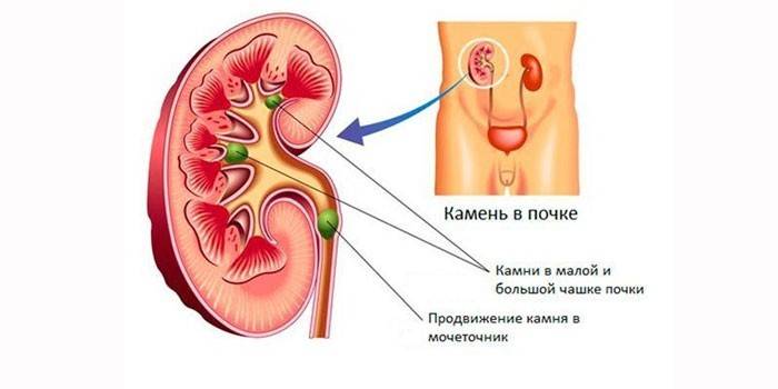 Мочекаменная болезнь