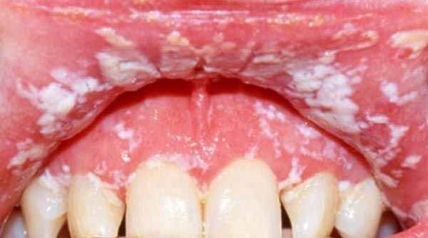 молочница