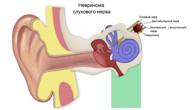 Неврит слухового нерва