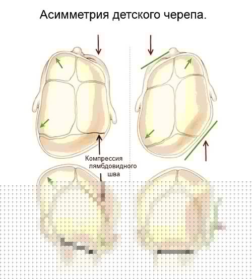 Первое последствие у младенцев при кривошеи - асимметрическое формирование черепа