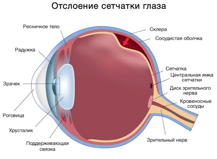 Отслоение сетчатки глаза
