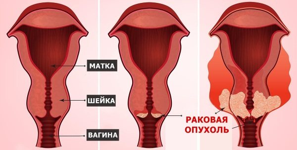 Плоскоклеточная карцинома шейки матки с тенденцией к ороговению. Что это такое, симптомы, прогноз, лечение