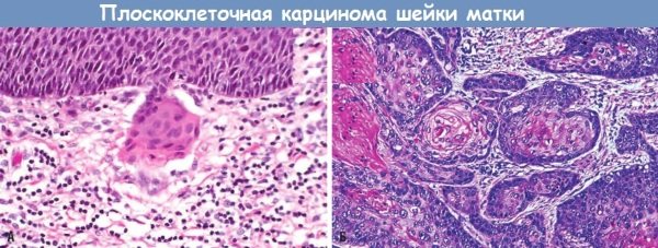 Плоскоклеточная карцинома шейки матки с тенденцией к ороговению. Что это такое, симптомы, прогноз, лечение