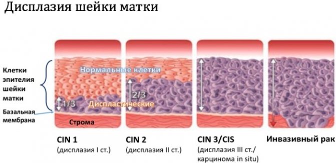 Плоскоклеточная карцинома шейки матки с тенденцией к ороговению. Что это такое, симптомы, прогноз, лечение