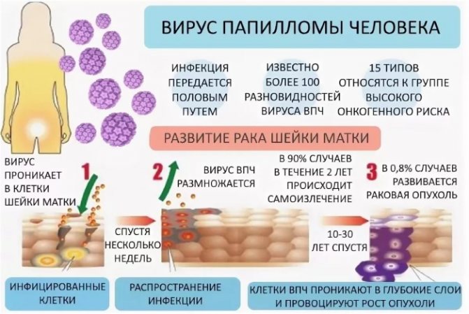 Плоскоклеточная карцинома шейки матки с тенденцией к ороговению. Что это такое, симптомы, прогноз, лечение