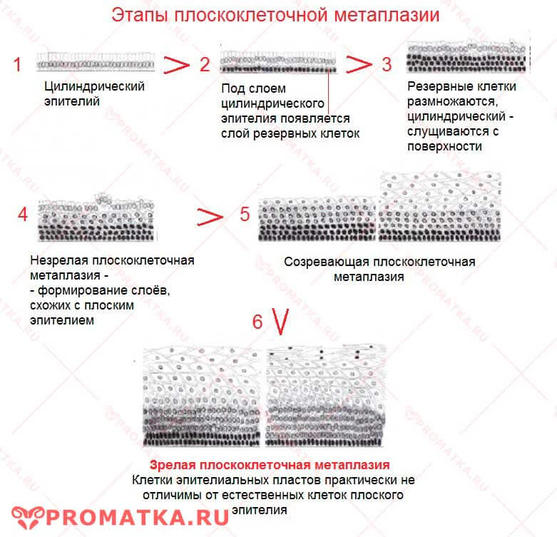 Плоскоклеточная метаплазия