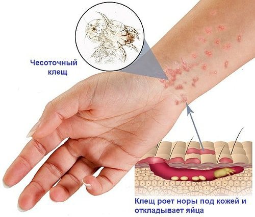 подкожные паразиты
