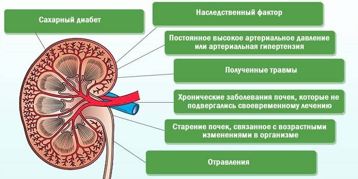 Причины образования конкрементов
