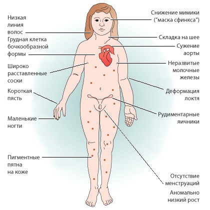 Признаки синдрома Шерешевского-Тернера Признаки синдрома Шерешевского-Тернера