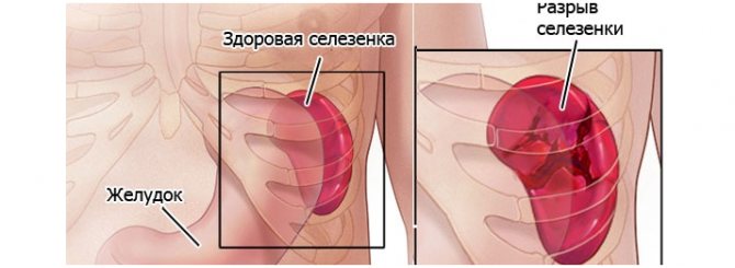 Разрыв селезенки