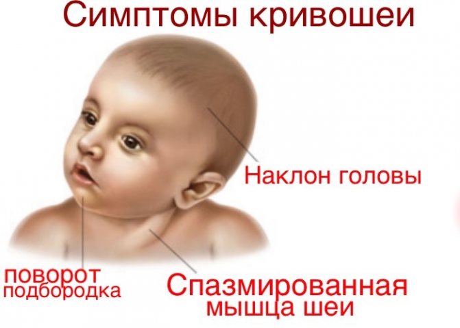 Симптомы кривошеи