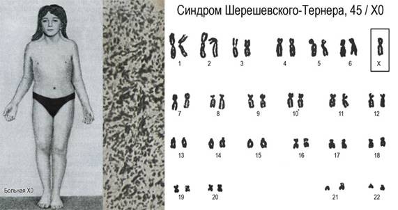 Синдром Шерешевского-Тернера Синдром Шерешевского-Тернера