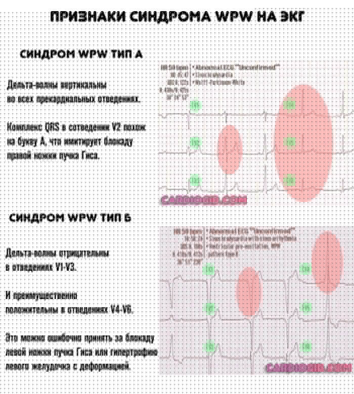 синдром-впв-на-экг