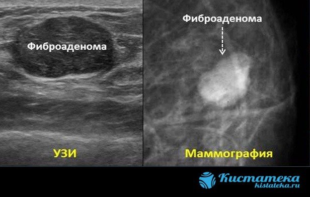 Среди доброкачественных очаговых изменений молочной железы встречаются липома, фибролипома, листовидная фиброаденома