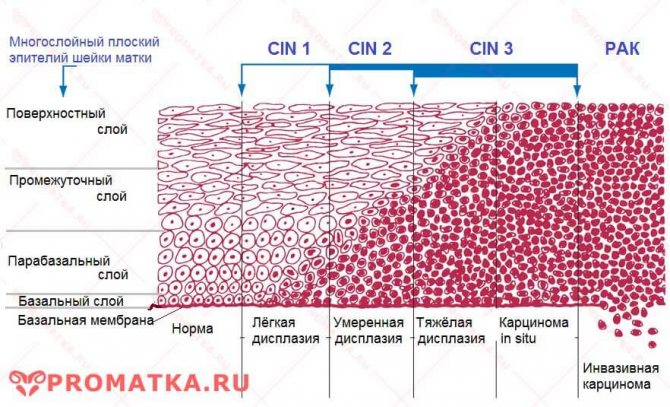 Степени цервикальной дисплазии