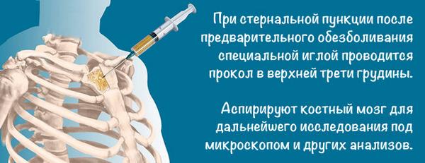 Стернальная пункция