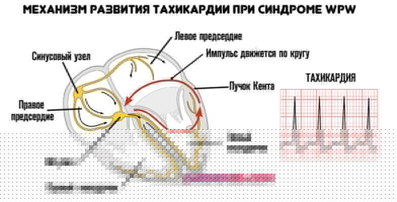 тахикардия-при-синдром-впв