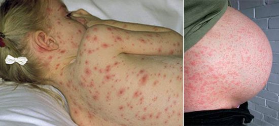 Varicella zoster у ребенка и беременной