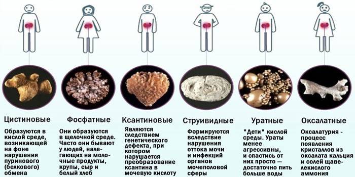 Виды почечных камней