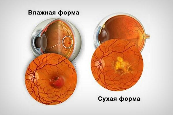 Влажная и сухая форма макулодистрофии