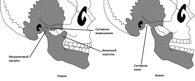 Вывих челюстного сустава