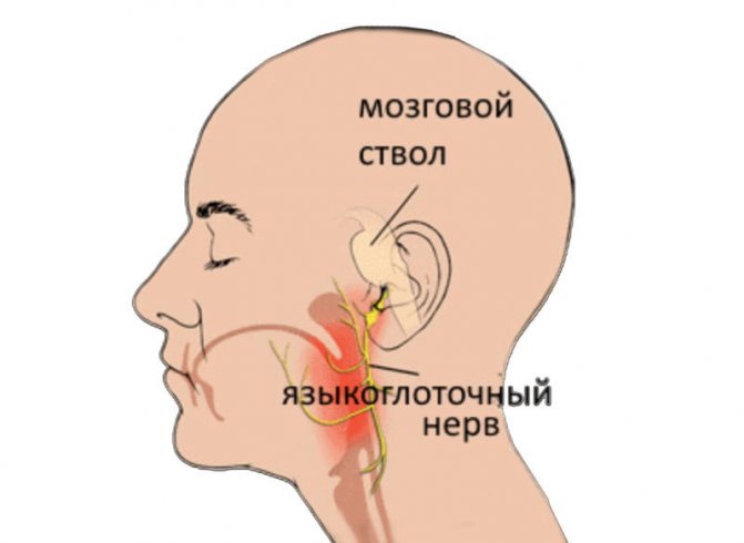 Языкоглоточная невралгия