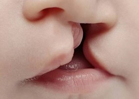 Заячья губа у детей, фото Заячья губа у детей, фото
